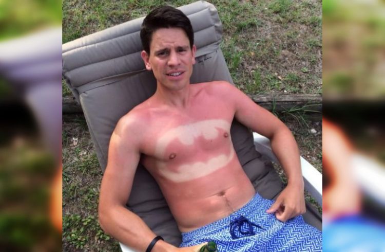 Жертвы солнечных лучей: 30 людей со смешным загаром
